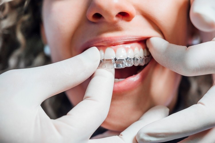 how Invisalign works