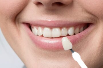 Veneers