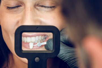 Veneers