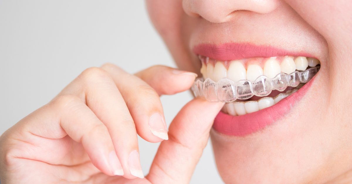 Invisalign