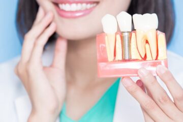 dental implants