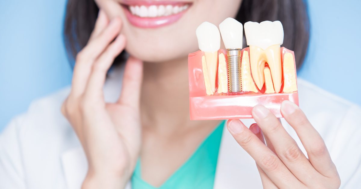 dental implants