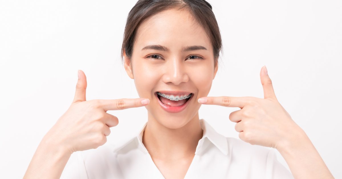 traditional braces