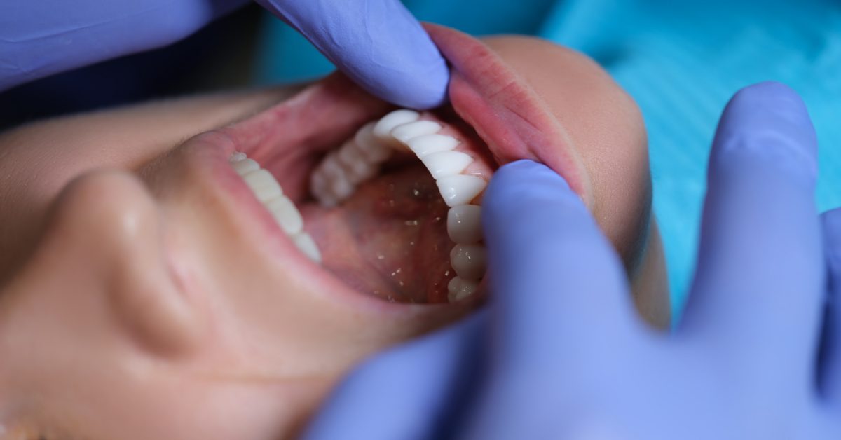 composite bonding