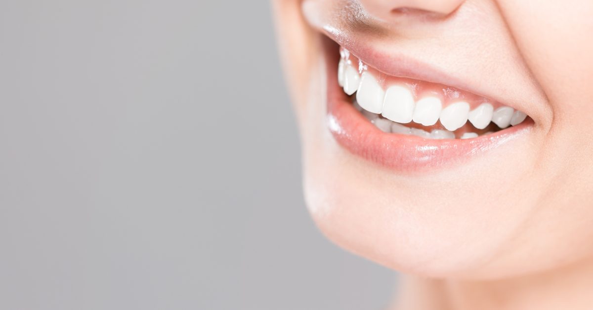 professional whitening