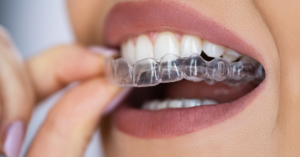 woman fitting her aligners