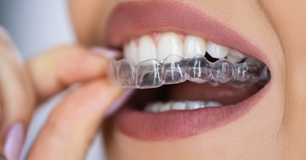 Aligners