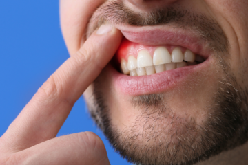 periodontal disease
